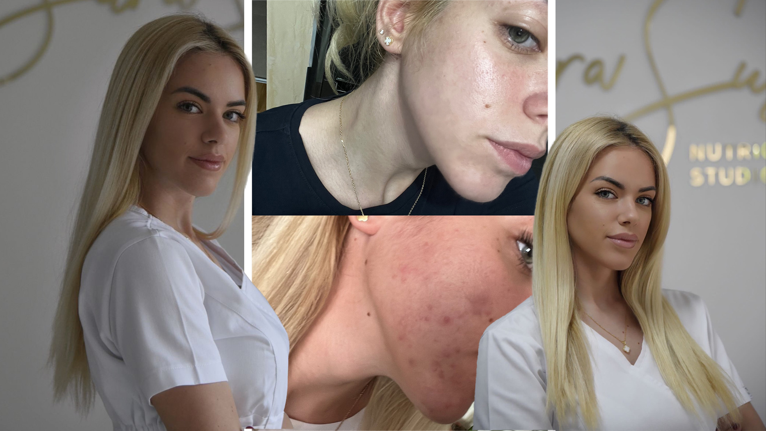 koža lica akne hrana