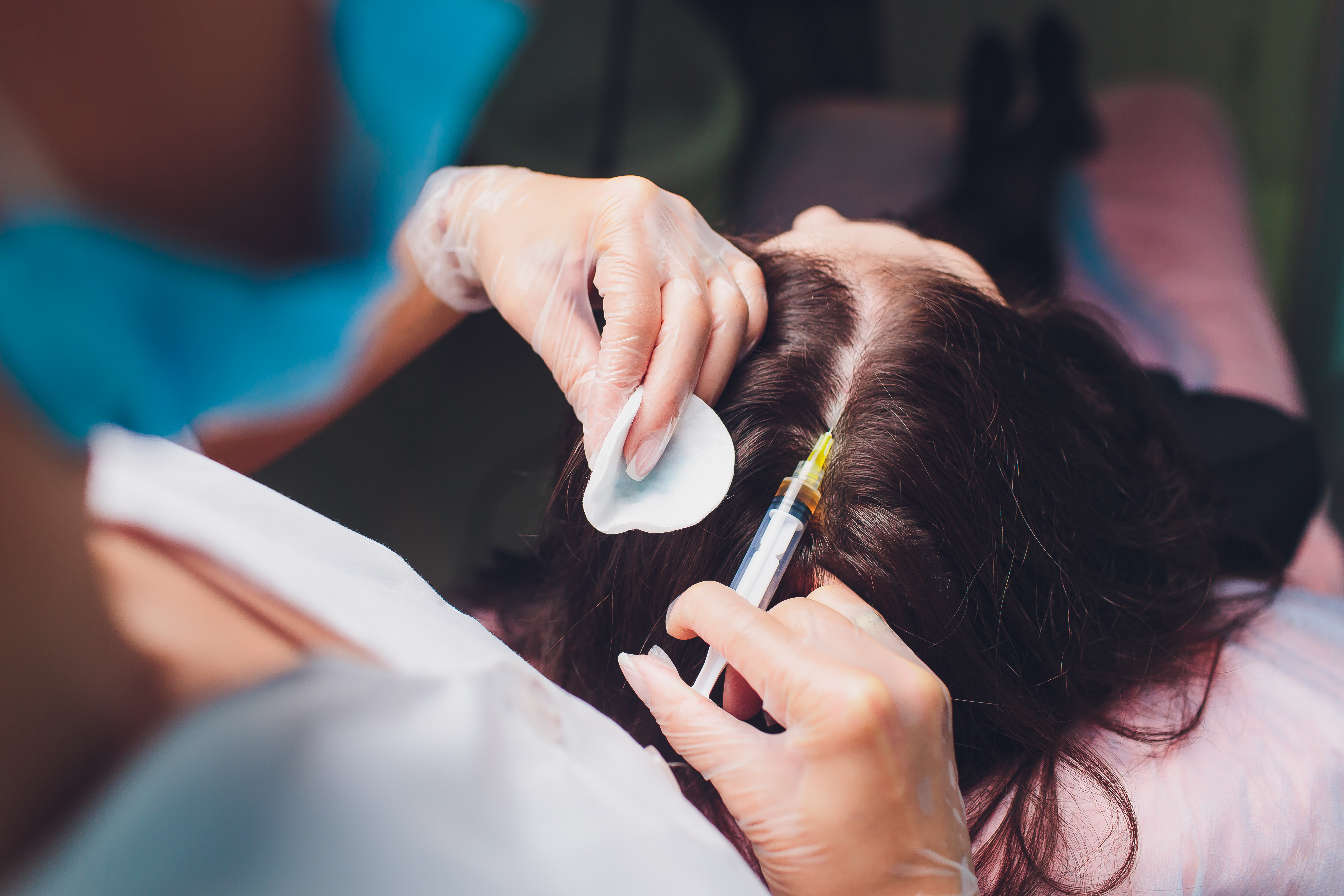 Platelet,Rich,Plasma,Injection,Procedure.,Hair,Growth,Stimulation.,Prp,Therapy