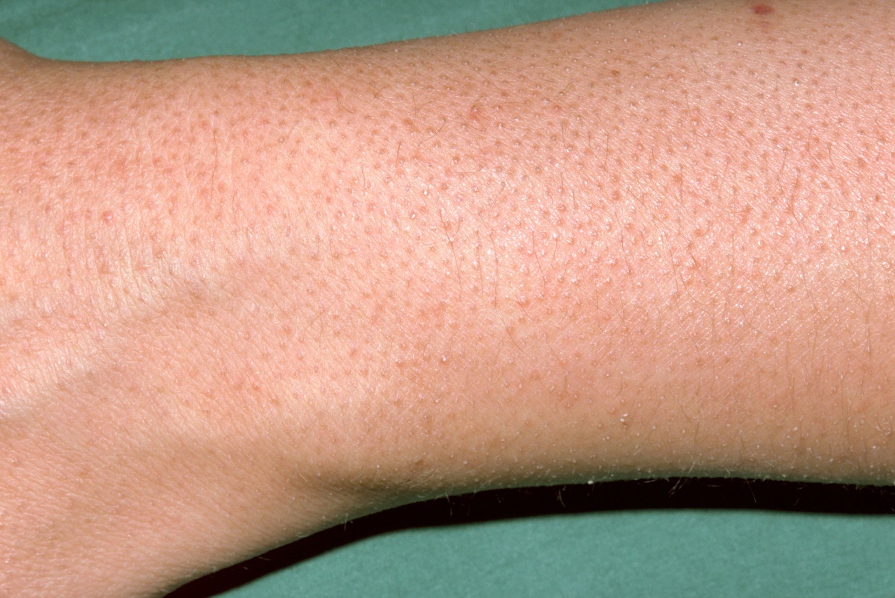 The arm of a patient with keratosis pilaris