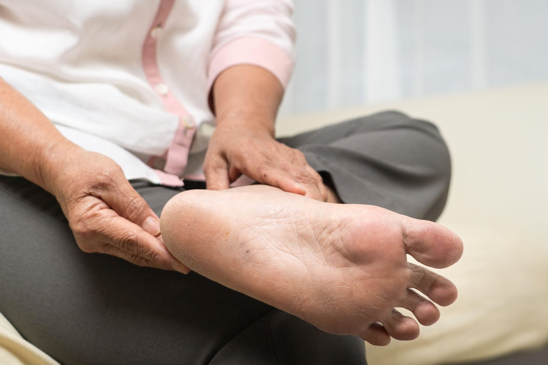 dry skin and cornea on senior woman foot