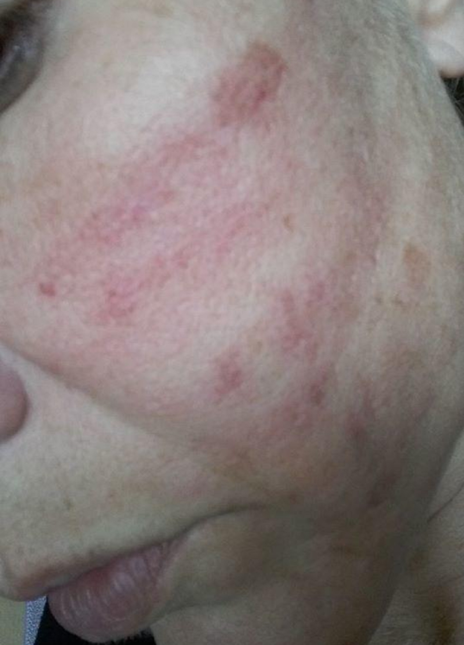 Dermapen