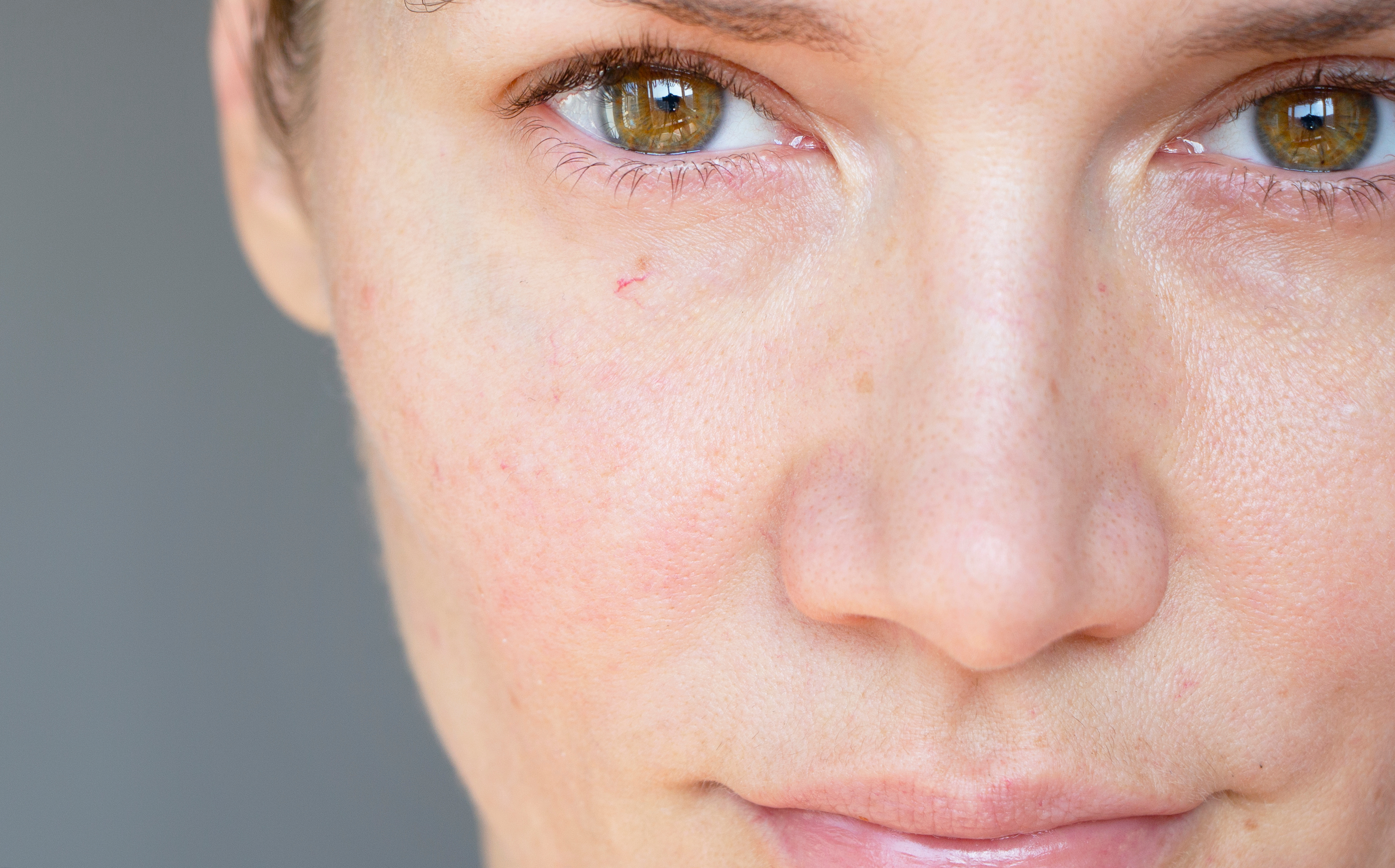 The,Girl,Has,Red,Vessels,On,Her,Face