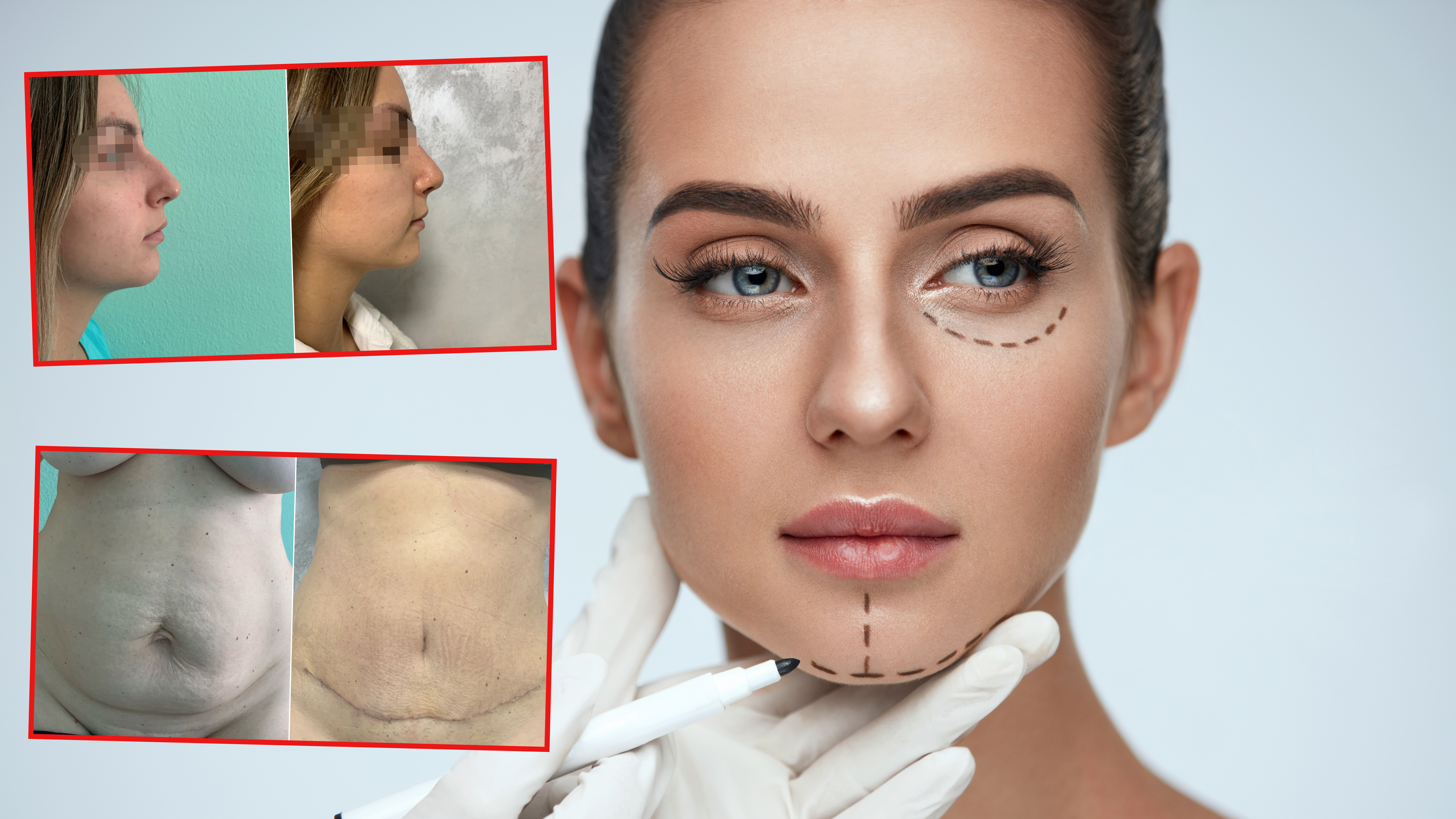 Beauty,Operation.,Closeup,Of,Beautician,Hand,Drawing,Surgical,Lines,On