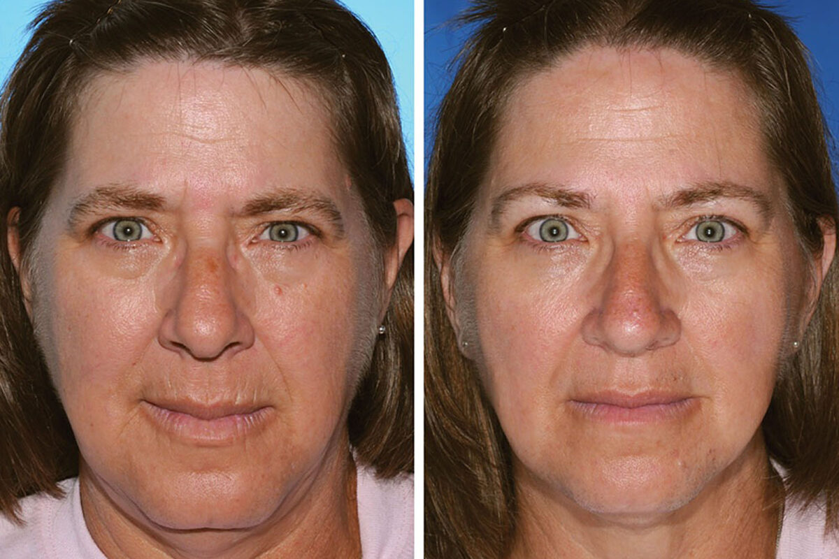 Кожа лица до и после курения